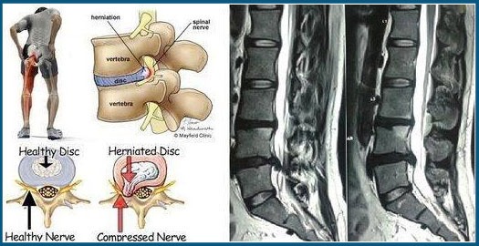 Slip Disc / Herniated Disc Tretment in Pune | Slip Disc / Herniated ...