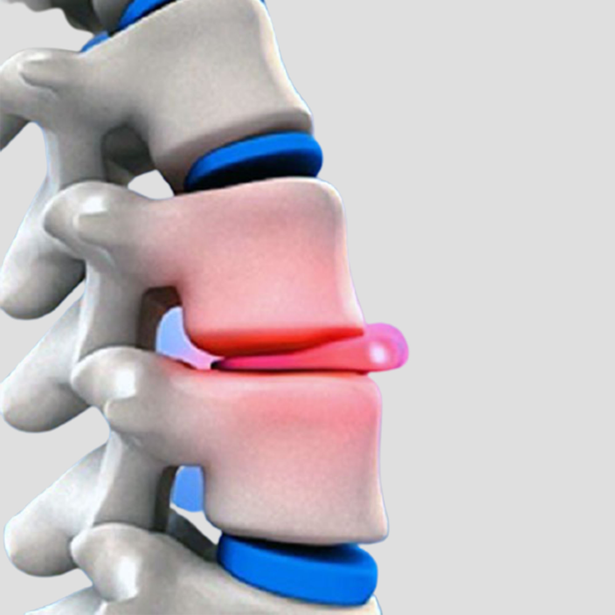 Slip Disc   Herniated Disc Tretment In Pune 